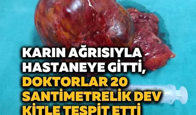 Karın ağrısıyla hastaneye gitti, doktorlar 20 santimetrelik dev kitle tespit etti